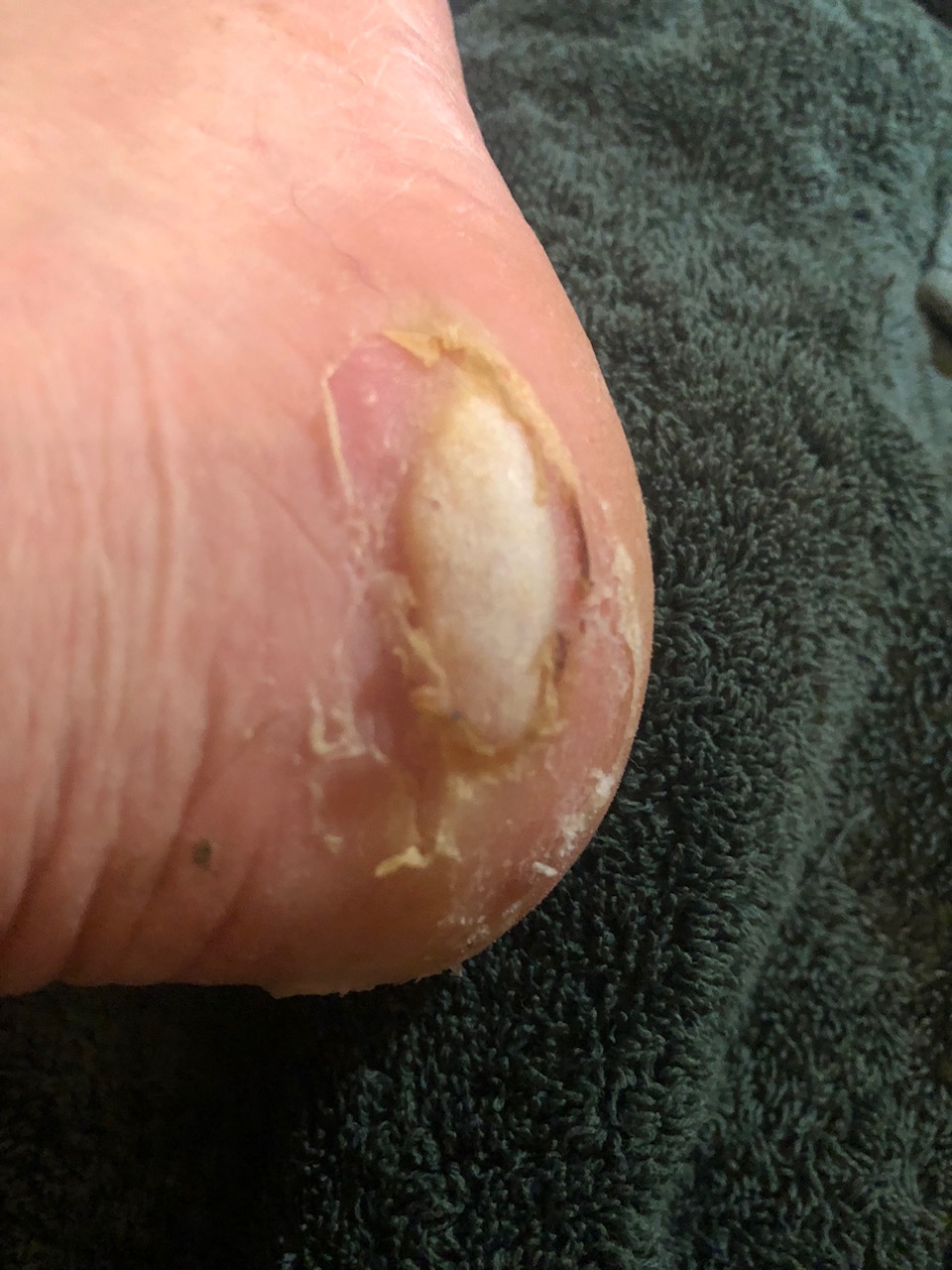 Right foot outer heel showing a very deep blister