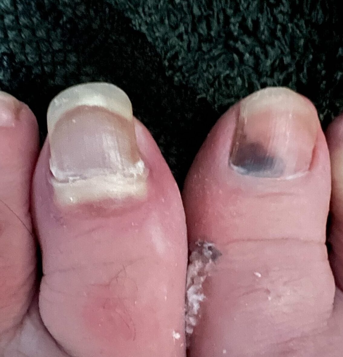 close up of big toes showing bruising