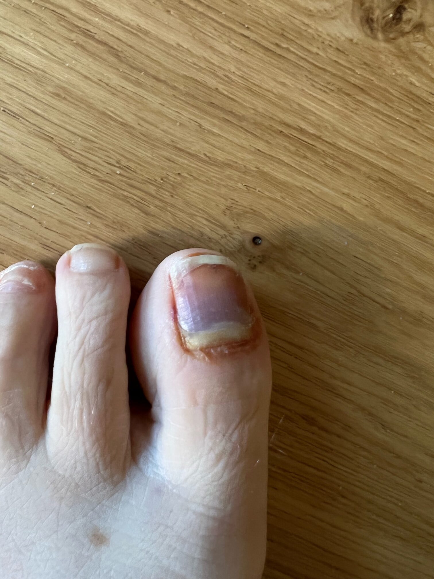 big toe showing deep bruising and bleeding