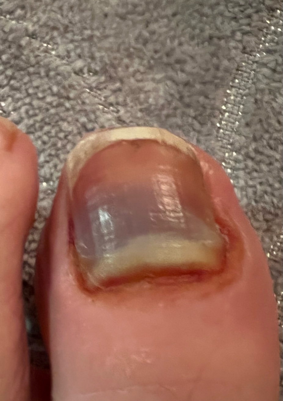 Big toe showing initial bruising