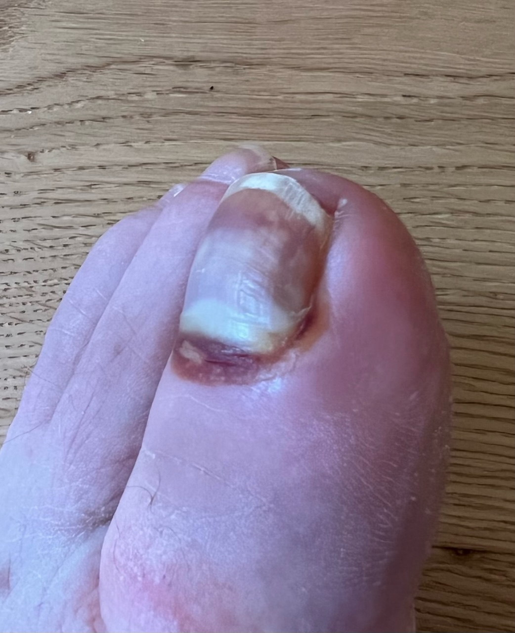Big toe showing bruising