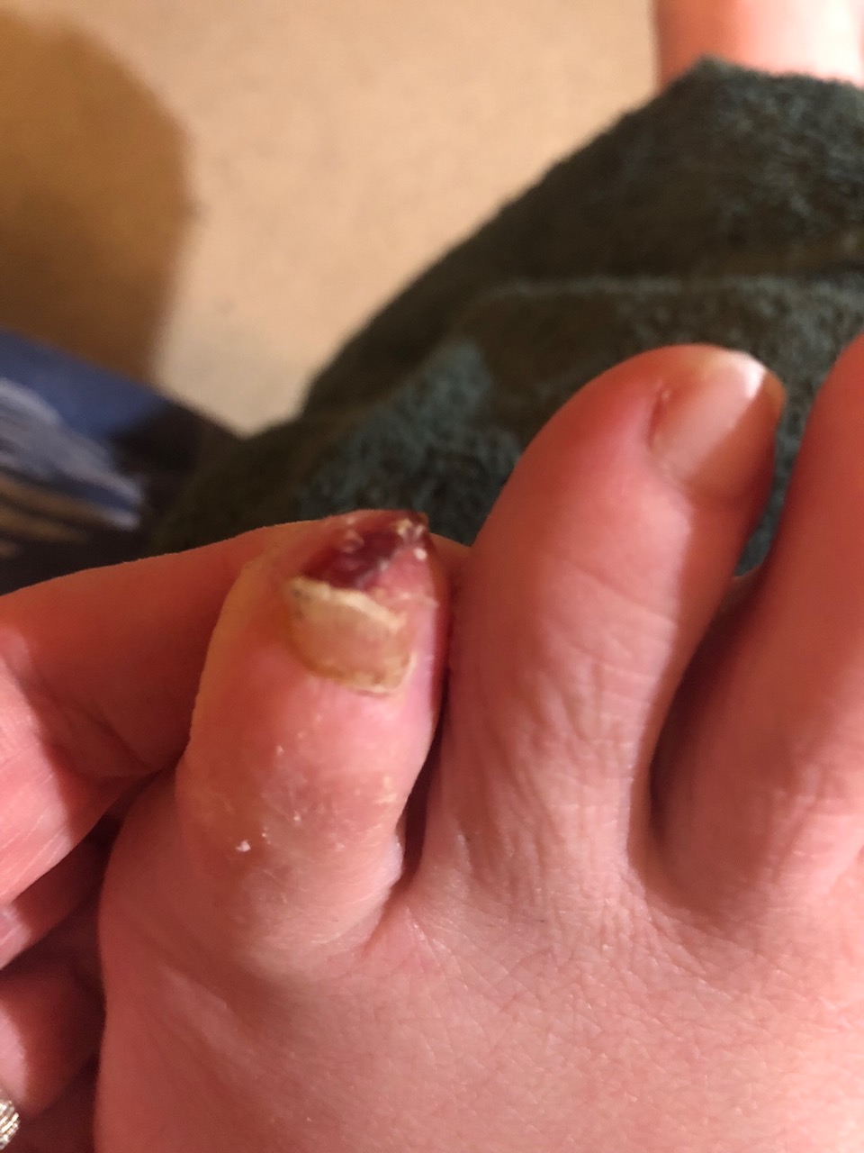 Left little toe split and bleeding