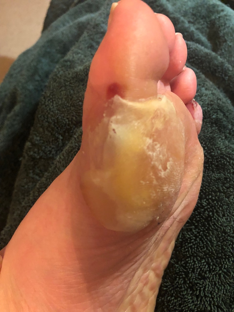 Left foot showing a very large blister across the ball of the foot