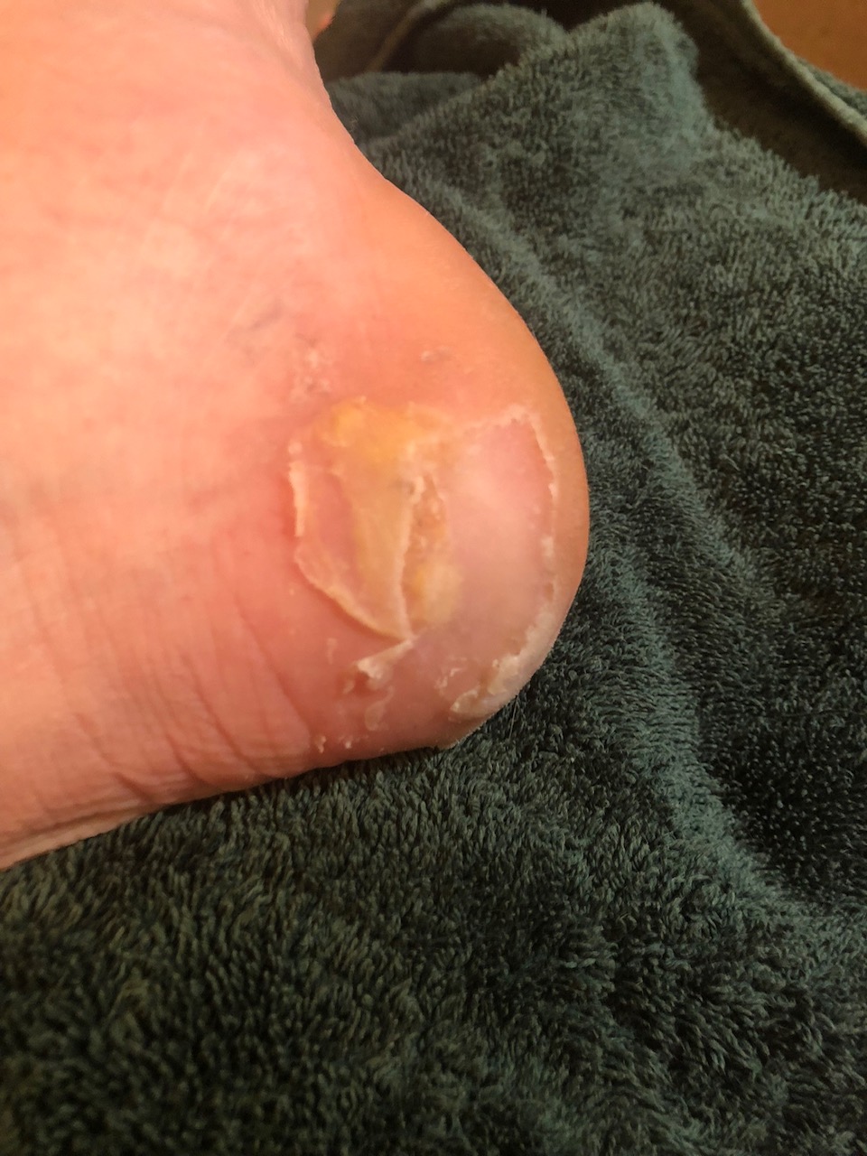 Left foot inner heel blister that goes through most of the skin